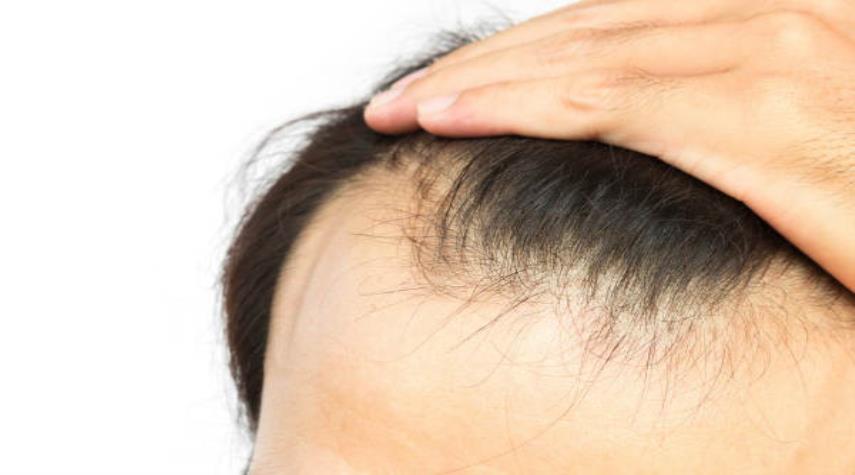 درمان باورنکردنی ریزش مو با نسخه های پیازی