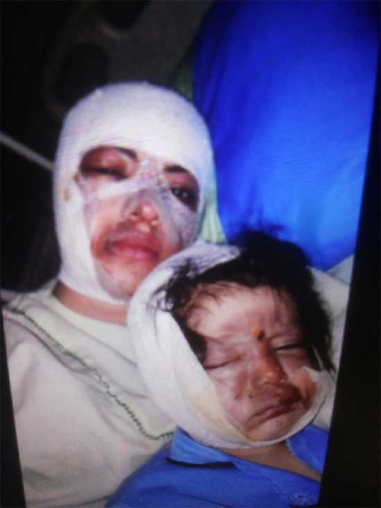 (تصویر) اسیدپاشی روی صورت عمه و برادرزاده اش